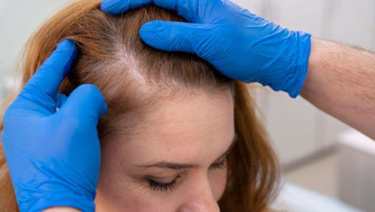 What Causes Hair Loss in Women?